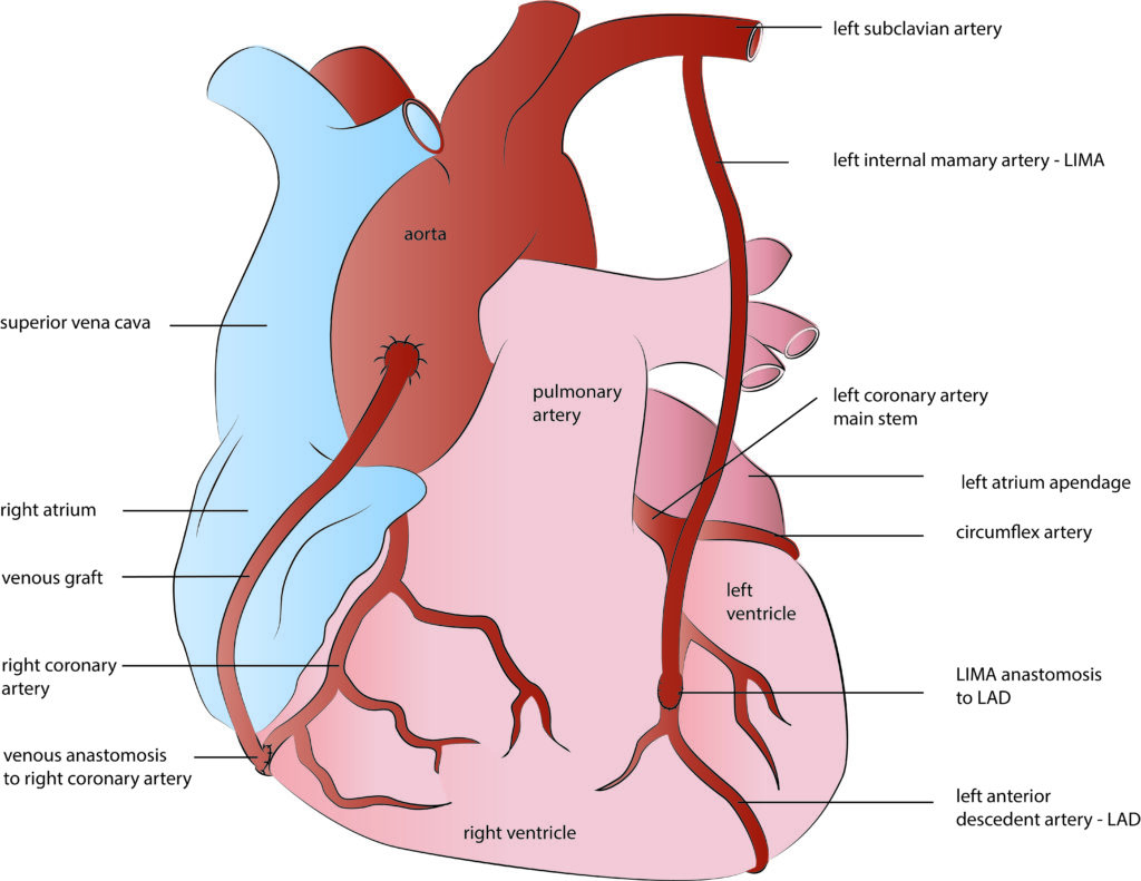 Coronary Artery Bypass Surgery CABG Kardiohirurgija.rs