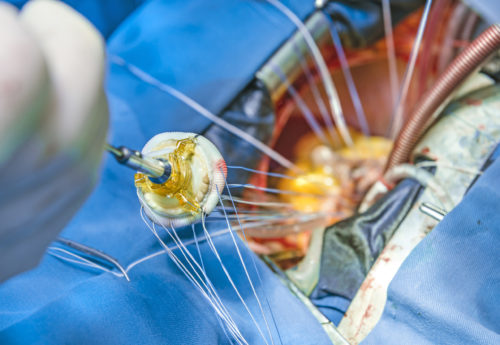 Implantation of a biological heart valve